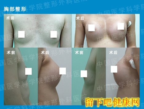 丰胸 假体隆胸 对比图片 效果图 丁小邦