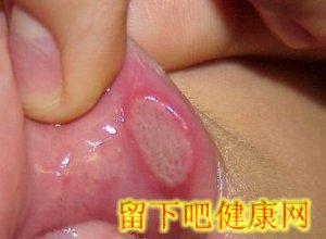 口腔溃疡的常识
