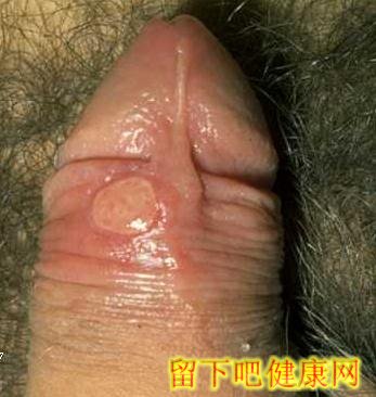 图解软下疳的临床症状