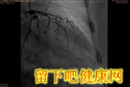 糖尿