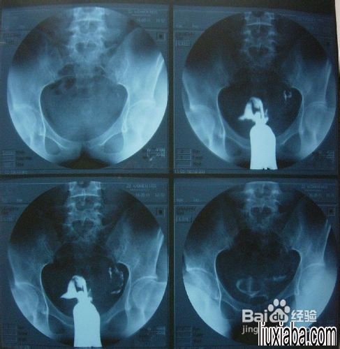 输卵管堵塞如何检查