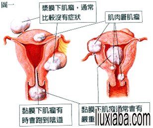 子宫肌瘤症状表现
