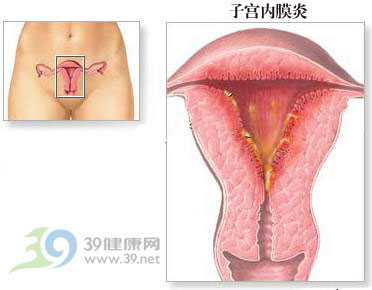 女性不可忽视的疾病:子宫内膜炎