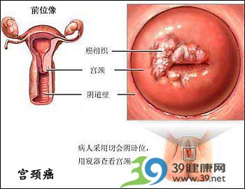 详解:远离宫颈癌的HPV检查