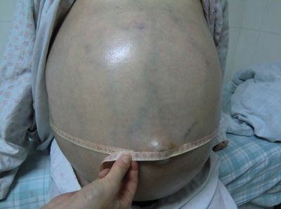 女子腹胀如鼓 手术取出10斤肿瘤14升积液