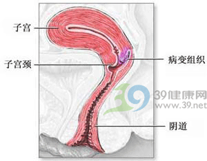 中医药更能缓解宫颈癌病人的痛苦!